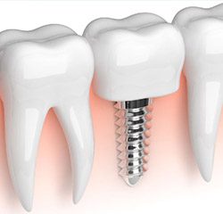  Trends to Watch: Dental Implant Technology